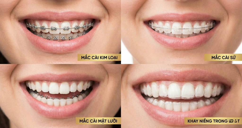 Trẻ 15 tuổi niềng răng bao nhiêu tiền? Có mắc không? 5 niềng răng cho trẻ dưới 14 tuổi
